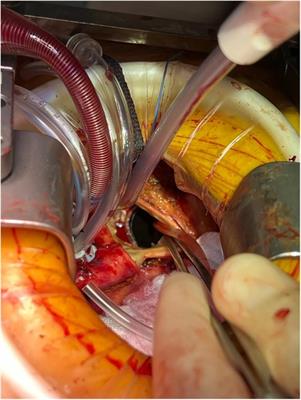 Right anterior mini thoracotomy for redo cardiac surgery: case series from North America and Europe